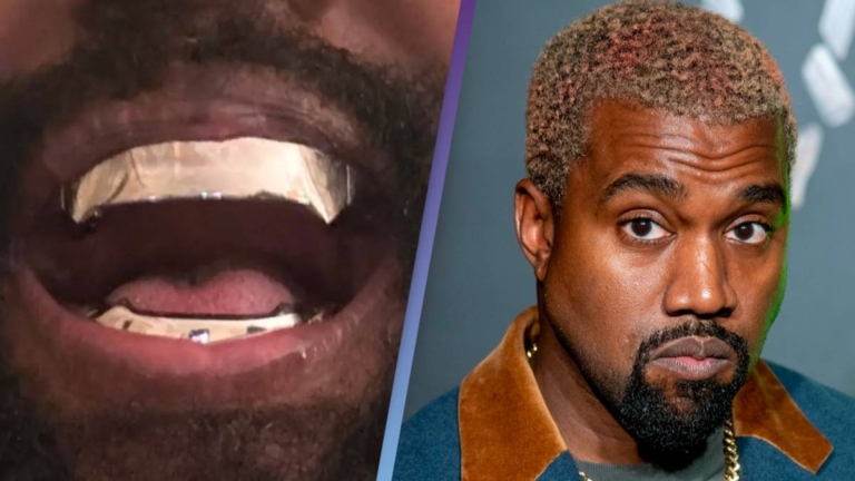 Kanye West’s 0,000 titanium teeth are ‘permanent’ and go ‘beyond veneers or grills’