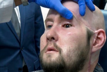 A man who received an eye and partial face transplant is examined by a doctor