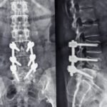 Luigi Mangione Said He Had Spondylolisthesis: What Is It?