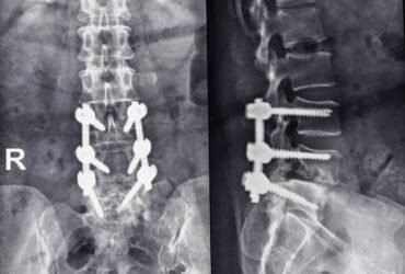 Luigi Mangione Said He Had Spondylolisthesis: What Is It?